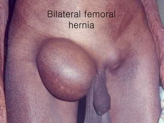 Bilateral femoral hernia 