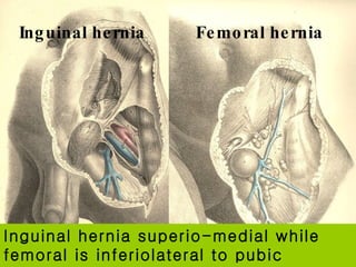 Inguinal hernia superio-medial while femoral is inferiolateral to pubic tubercle   Inguinal hernia Femoral hernia 