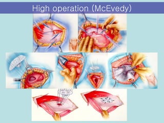 High operation (McEvedy) 