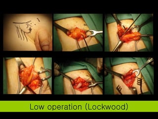 Low operation (Lockwood) 
