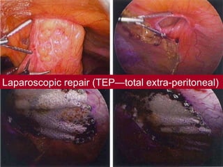 Laparoscopic repair (TEP—total extra-peritoneal) 
