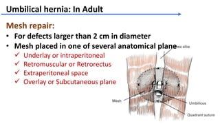 Femoral hernia with umbilical hernia | PPTX