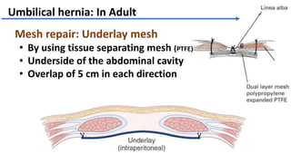 Femoral hernia with umbilical hernia | PPTX