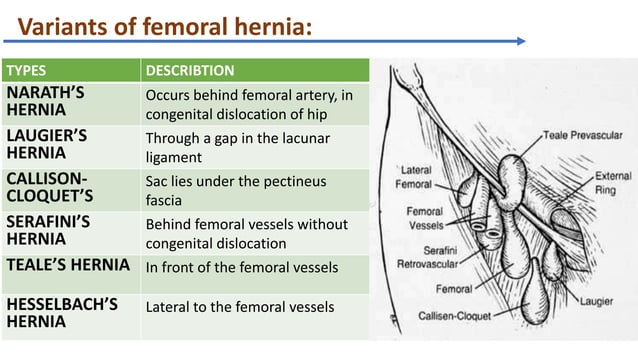 Femoral hernia with umbilical hernia | PPT