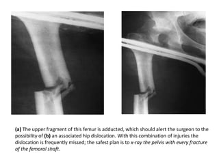 (a) The upper fragment of this femur is adducted, which should alert the surgeon to the
possibility of (b) an associated hip dislocation. With this combination of injuries the
dislocation is frequently missed; the safest plan is to x-ray the pelvis with every fracture
of the femoral shaft.
 