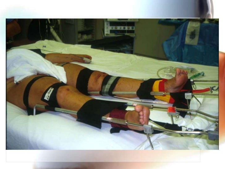 Femoral shaft fractures