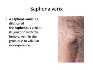 Saphena varix
• A saphena varix is a
dilation of
the saphenous vein at
its junction with the
femoral vein in the
groin due to valvular
incompetence.
 