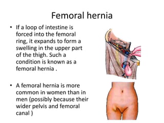 Femoral hernia
• If a loop of intestine is
forced into the femoral
ring, it expands to form a
swelling in the upper part
of the thigh. Such a
condition is known as a
femoral hernia .
• A femoral hernia is more
common in women than in
men (possibly because their
wider pelvis and femoral
canal )
 