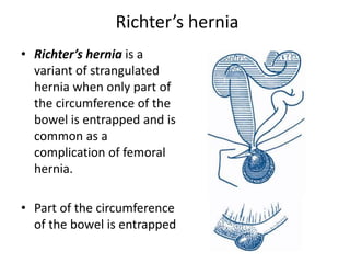 Richter’s hernia
• Richter’s hernia is a
variant of strangulated
hernia when only part of
the circumference of the
bowel is entrapped and is
common as a
complication of femoral
hernia.
• Part of the circumference
of the bowel is entrapped
 