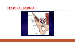 FEMORAL HERNIA
 