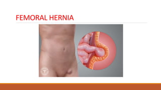 FEMORAL HERNIA
 