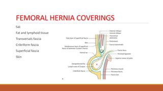 FEMORAL HERNIA COVERINGS
Sac
Fat and lymphoid tissue
Transversals fascia
Cribriform fascia
Superficial fascia
Skin
 