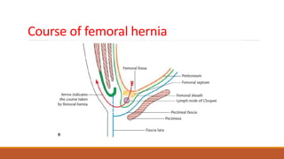 Course of femoral hernia
 