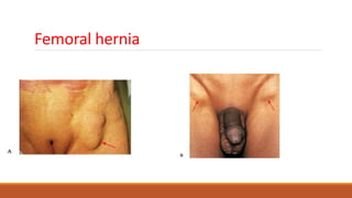 Femoral hernia
 