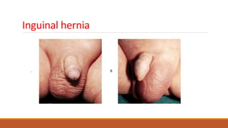Inguinal hernia
 