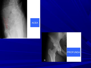 Femoro Acetabular Impingement Syndrome Femoro Acetabular Impingement Syndrome