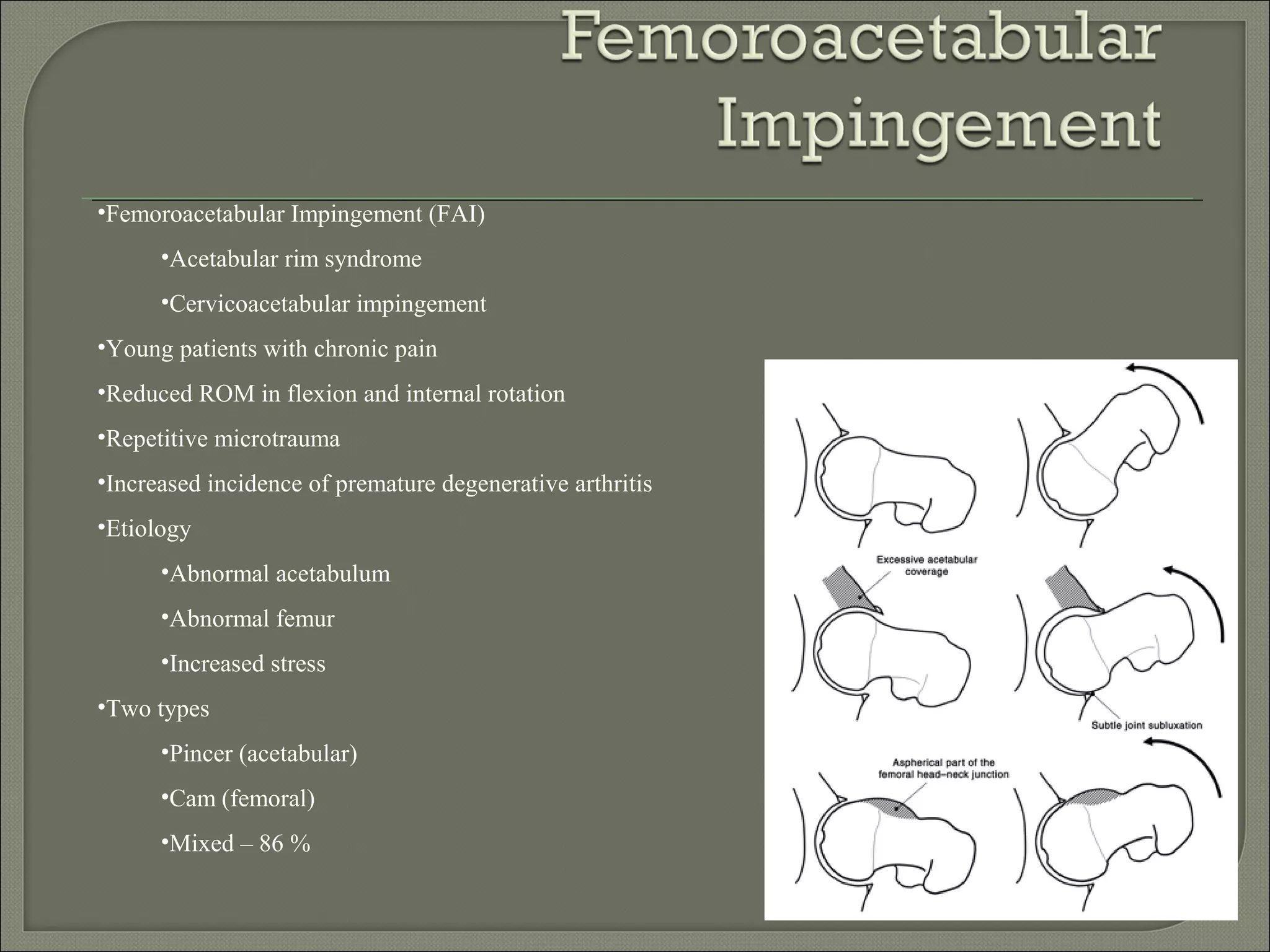 Femoroacetabular%20 impingement[1] | PPT