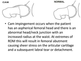 • Cam impingement occurs when the patient
has an aspherical femoral head and there is an
abnormal head/neck junction with an
increased radius at the waist. At extremes of
ROM this will result in femoral abutment
causing sheer stress on the articular cartilage
and a subsequent labral tear or detachment.

 