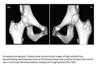 Computed tomography 3-dimensional reconstructed images of right and left hips,
demonstrating small protuberances of the femoral head-neck junction (arrows) that can be
seen in cam-type femoroacetabular impingement (right greater than left).

 