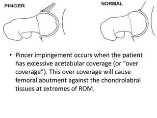 • Pincer impingement occurs when the patient
has excessive acetabular coverage (or “over
coverage”). This over coverage will cause
femoral abutment against the chondrolabral
tissues at extremes of ROM.

 