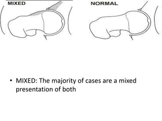 • MIXED: The majority of cases are a mixed
presentation of both

 