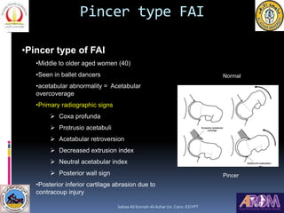 Femoroacetabular impingement (FAI) | PPT