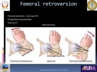 Femoral retroversion
•Femoral retroverion – Cam type FAI
•Congenital or post traumatic
•Calc by CT
•Normal torsion
•Retrot...