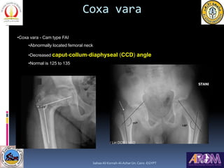 Coxa vara
•Coxa vara - Cam type FAI
•Abnormally located femoral neck
•Decreased caput-collum-diaphyseal (CCD) angle
•Norma...