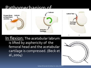 Pathomechanism of
Cam FAI
In extension: The asphericity of
the femoral head does not
interfer with the acetabular
labrum.
...