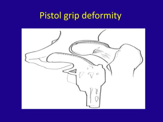 Femoroacetabular impingement syndrome | PPTX