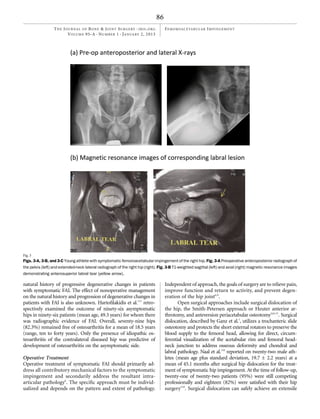 Femoroactabular impingement | PDF
