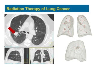 Radiation Therapy of Lung Cancer
 