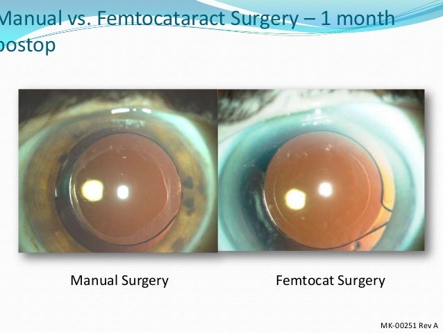 Femtosecond Laser Cataract Surgery Is This The Future?