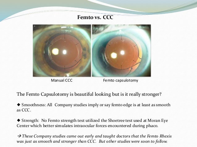 FLACS ie Femtosecond Laser Assisted Cataract Surgery