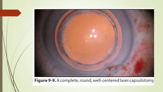 Femtosecond laser assisted cataract surgery | PPTX