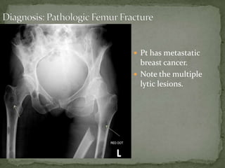  Pt has metastatic

breast cancer.
 Note the multiple
lytic lesions.

 