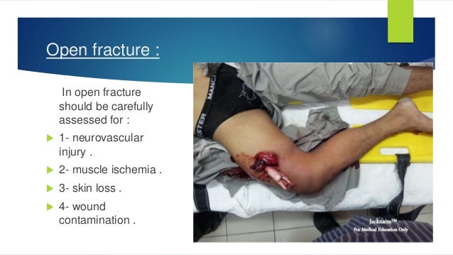 fracture of shaft of femur