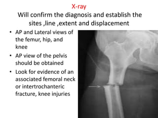 X-ray
Will confirm the diagnosis and establish the
sites ,line ,extent and displacement
• AP and Lateral views of
the femur, hip, and
knee
• AP view of the pelvis
should be obtained
• Look for evidence of an
associated femoral neck
or intertrochanteric
fracture, knee injuries
 