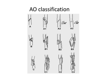 AO classification
 
