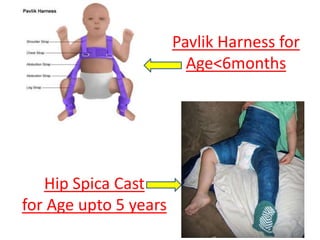 Pavlik Harness for
Age<6months
Hip Spica Cast
for Age upto 5 years
 