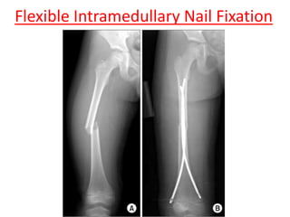 Flexible Intramedullary Nail Fixation
 