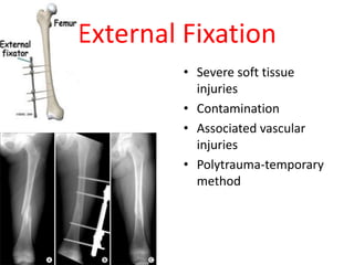 External Fixation
• Severe soft tissue
injuries
• Contamination
• Associated vascular
injuries
• Polytrauma-temporary
method
 