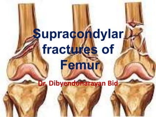 Supracondylar
fractures of
Femur
Dr. Dibyendunarayan Bid
 