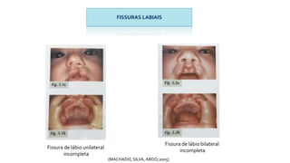 FISSURAS LABIAIS
Fissura de lábio unilateral
incompleta
Fissura de lábio bilateral
incompleta
(MACHADO, SILVA, ABDO;2005)
 