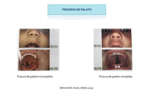 FISSURAS DE PALATO
(MACHADO, SILVA, ABDO;2005)
Fissura de palato incompleta Fissura de palato completa
 