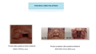 FISSURAS LÁBIO-PALATINAS
Fenda Lábio-palatina total unilateral Fenda completa Lábio-palatina bilateral
(WAES, STÖCKLI; 2002) (MACHADO, SILVA, ABDO;2005)
 