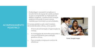 ACOMPANHAMENTO
PEDIÁTRICO
 A abordagem neonatal é complexa e o
envolvimento da equipe de saúde auxiliará
os pais a compreender as implicações do
defeito congênito, o potencial de correção
estética e funcional, e como a tomar
medidas que minimizem as comorbidades.
O manejo pediátrico pós-natal imediato
demanda decisões críticas, como quanto
1. À forma de alimentação e higienização da
criança;
2. A investigação de anomalias associadas e
o encaminhamento para avaliação
genético-clínica;
3. Para correção cirúrgica em centros de
referência.
Fonte: Google Images
 