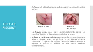 TIPOS DE
FISSURA
 As fissuras de lábio e/ou palato podem apresentar-se de diferentes
formas:
Fissura de Lábio Fissura de
Lábio e alvéolo
 Na fissura labial, pode haver comprometimento parcial ou
completo do lábio, unilateralmente ou bilateralmente.
 As fissuras de lábio e alvéolo incompletas afetam parcialmente o
rebordo alveolar, mas sem provocar a sua ruptura. Quanto
completas, a ruptura do rebordo atinge o forame incisivo e
provoca a divisão da maxila em sua porção anterior
unilateralmente.
 