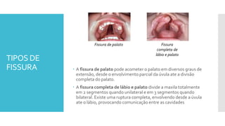 TIPOS DE
FISSURA
Fissura de palato
 A fissura de palato pode acometer o palato em diversos graus de
extensão, desde o envolvimento parcial da úvula ate a divisão
completa do palato.
 A fissura completa de lábio e palato divide a maxila totalmente
em 2 segmentos quando unilateral e em 3 segmentos quando
bilateral. Existe uma ruptura completa, envolvendo desde a úvula
ate o lábio, provocando comunicação entre as cavidades
Fissura
completa de
lábio e palato
 