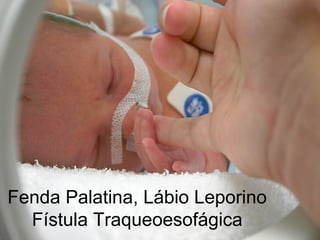 Fenda Palatina, Lábio Leporino
  Fístula Traqueoesofágica
 